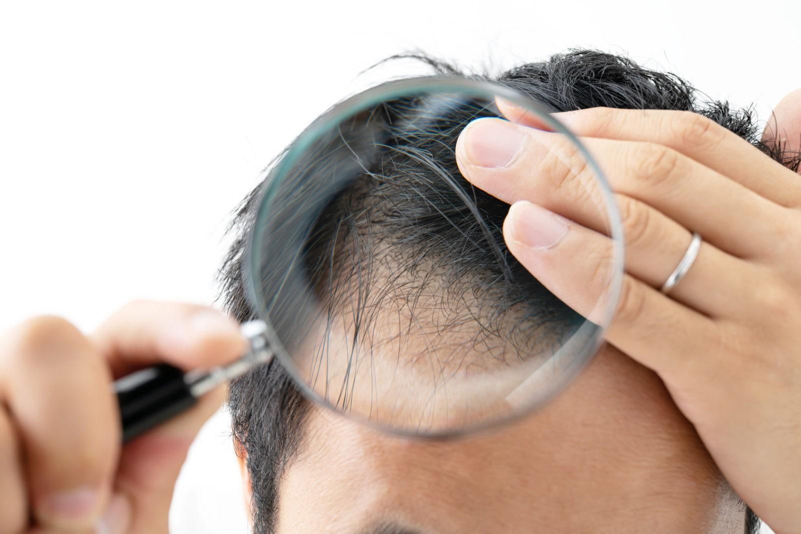 Чому випадає волосся у чоловіків: ознаки, причини, лікування